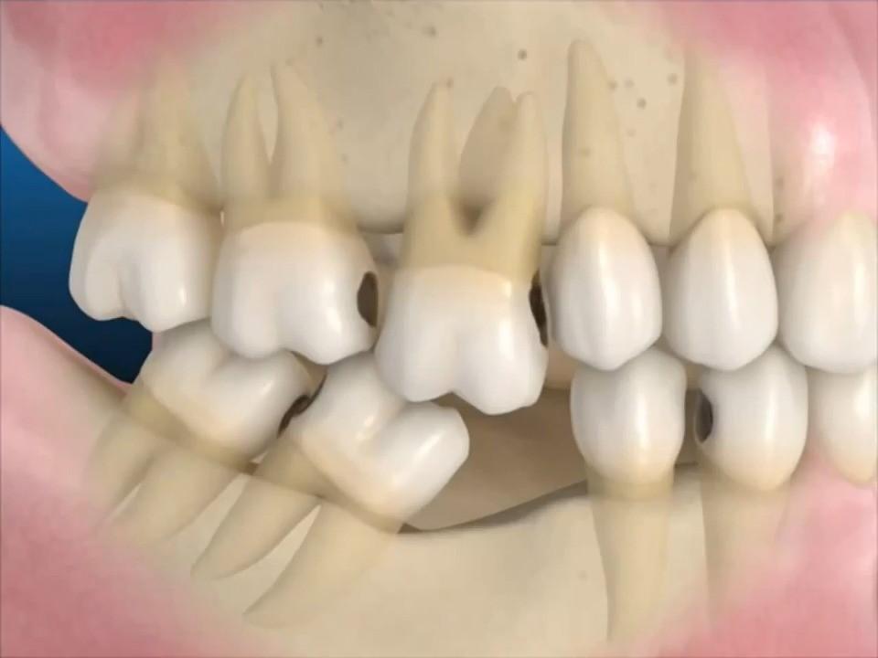 Hậu quả của việc mất răng