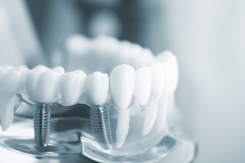 trồng răng implant