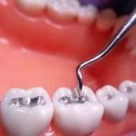 Hàn răng sâu có tốt hay không? Cần lưu ý những điều gì?