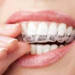 7 lợi ích niềng răng trong suốt invisalign mang lại cho bạn