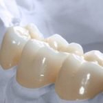 Bọc răng sứ Cercon là gì? Ưu điểm và cách chăm sóc hiệu quả