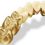 Bọc răng sứ kim loại: Các ưu nhược điểm cần biết trước khi bọc