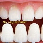 Bọc răng sứ Veneer có tốt không? Có đau không? Giá bao nhiêu tiền?
