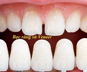 boc-rang-su-veneer