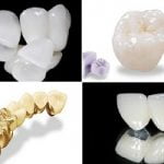Cập nhật bảng giá các loại răng sứ thẩm mỹ mới nhất tại Hà Nội