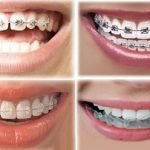 Bảng giá và chi phí niềng răng hiện nay là bao nhiêu?
