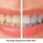 Giá tẩy trắng răng bao nhiêu? Nên chọn tại nha khoa hay ở nhà?