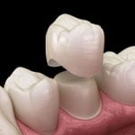 Kinh nghiệm bọc răng sứ chọn loại răng nào? Lưu ý gì trước khi bọc?