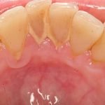 Lấy cao răng bằng máy siêu âm: Giá cả và ưu điểm