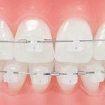 Niềng răng bao nhiêu tiền? Chi tiết bảng giá niềng răng mới nhất