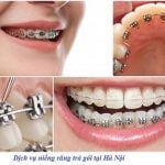 Dịch vụ niềng răng trả góp Hà Nội với lãi suất hấp dẫn 0%
