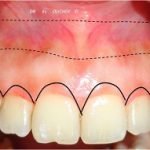 Phẫu thuật cười hở lợi và những điều bạn cần phải biết