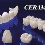 Vì sao nên bọc răng sứ Ceramill? Giá răng sứ Ceramill bao nhiêu tiền?
