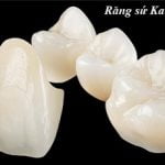 Bọc răng sứ Katana có tốt không? Giá bao nhiêu và quy trình bọc