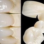 So sánh răng sứ Katana và Venus: Nên chọn bọc răng nào?