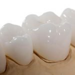 Bọc răng sứ Venus và những điều bạn cần biết trước khi bọc