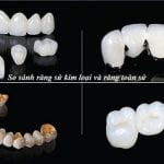 So sánh răng sứ kim loại và răng toàn sứ nên bọc loại răng nào?