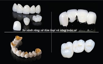 so-sanh-rang-su-kim-loai-rang-toan-su