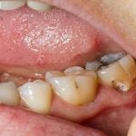 Bọc sứ răng sâu khi nào nên bọc? Những điều phải biết trước làm