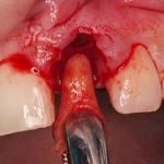 Nhổ răng người lớn khi nào cần nhổ? Quy trình và lưu ý khi nhổ răng