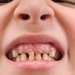 Nhổ răng trẻ em nên tự nhổ hay đến nha khoa? Các lưu ý sau khi nhổ
