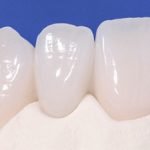 Răng sứ Emax có mấy loại? Ưu điểm là gì? Giá bọc bao nhiêu 1 răng?