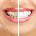 Tẩy trắng răng Laser Zoom II: Hiện đại, hiệu quả nhanh nhất hiện nay