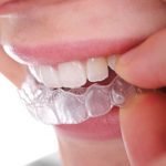 Tẩy trắng răng bằng máng: Ưu điểm, quy trình và lưu ý sau khi tẩy