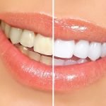 Tẩy trắng răng: Những điều cần biết trước, trong và sau khi tẩy