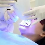 Tẩy trắng răng bằng Laser 4 công nghệ và 5 điều bạn cần biết