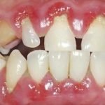 Viêm nha chu là gì? Nguyên nhân, triệu chứng và phương pháp điều trị