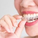 Niềng răng trong suốt Zenyum tại Hà Nội những điều bạn cần biết