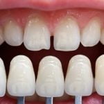 Bọc răng sứ không mài là gì? Giá bao nhiêu? Tuổi thọ bao lâu?