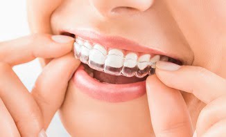 nieng-rang-trong-suot-Invisalign