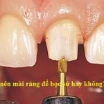Có nên mài răng để bọc sứ hay không? Có đau không?