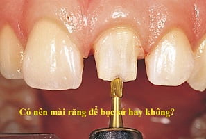 co-nen-mai-rang-de-boc-su