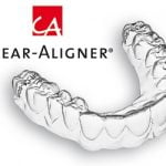Lý do niềng răng trong suốt Clear Aligner được nhiều người lựa chọn