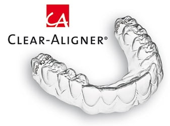 ly-do-chon-nieng-rang-trong-suot-clear-aliger