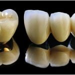 Răng sứ titan và răng toàn sứ: Chọn loại răng nào tốt nhất