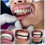 Bọc răng sứ có đau không? Bọc răng sứ giá bao nhiêu tiền?