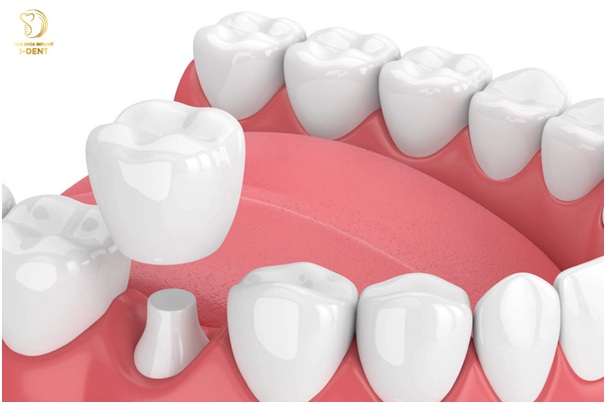 boc-rang-su-co-tot-khong