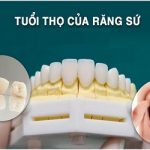 Bọc răng sứ có tốt không? Bọc răng sứ ở đâu uy tín nhất?