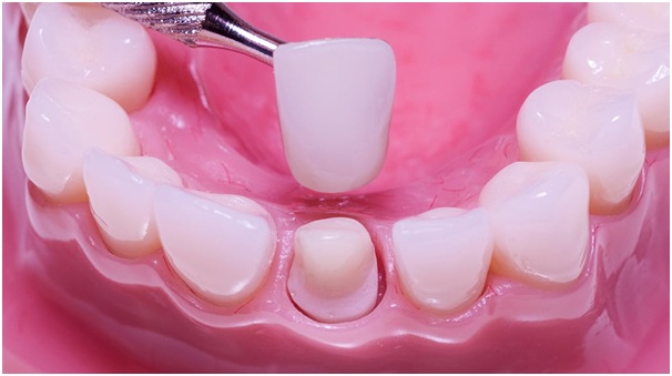 boc-rang-su-co-tot-khong2