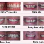 Bọc răng sứ và những thông tin hữu ích mà bạn không thể bỏ lỡ