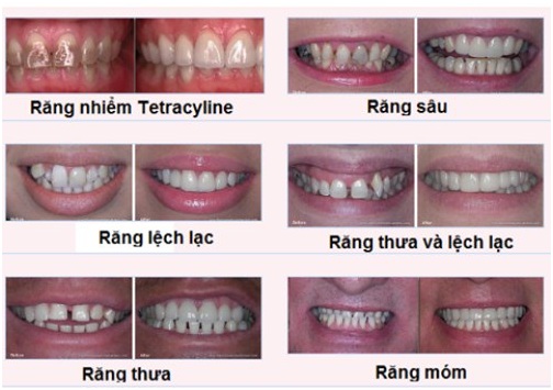 boc-rang-su-va-nhung-thong-tin-can-biet1