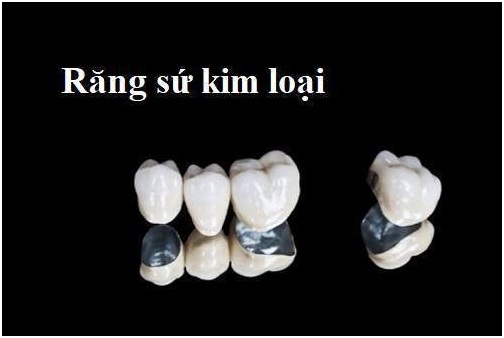 boc-rang-su-va-nhung-thong-tin-can-biet2