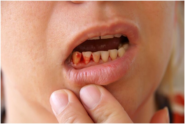 chay-mau-chan-rang-la-gi