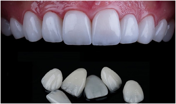 mat-dan-su-veneer