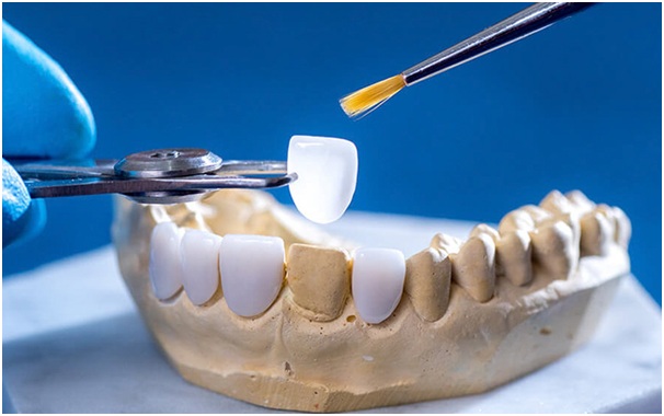 mat-dan-su-veneer1