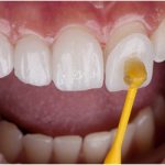 Nên dán sứ hay bọc sứ? Lời khuyên từ các chuyên gia nha khoa